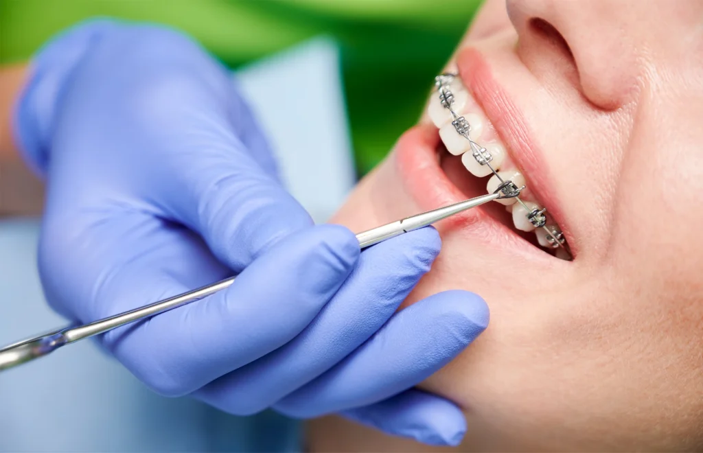Use of Nitinol in orthodontic arches