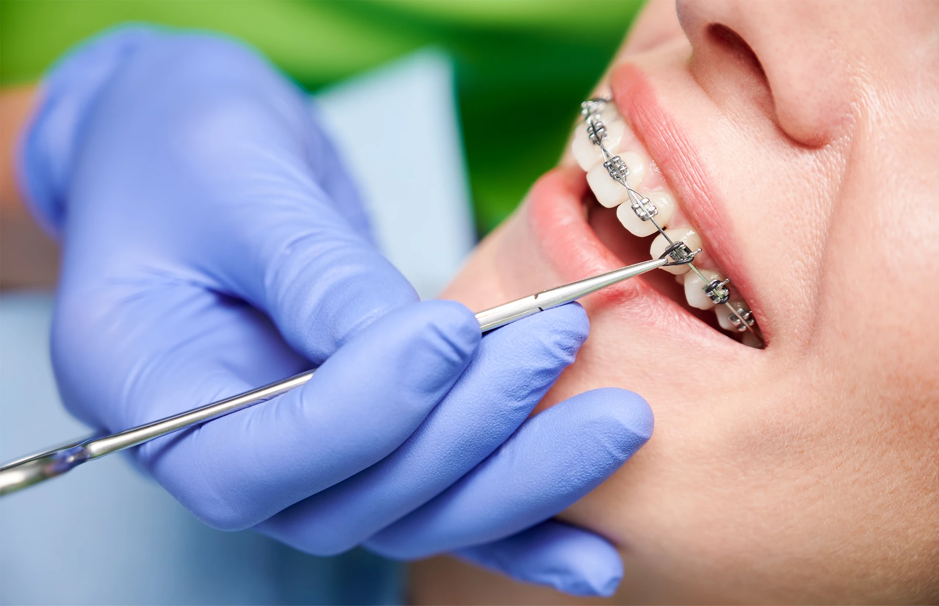 Use of Nitinol in orthodontic arches